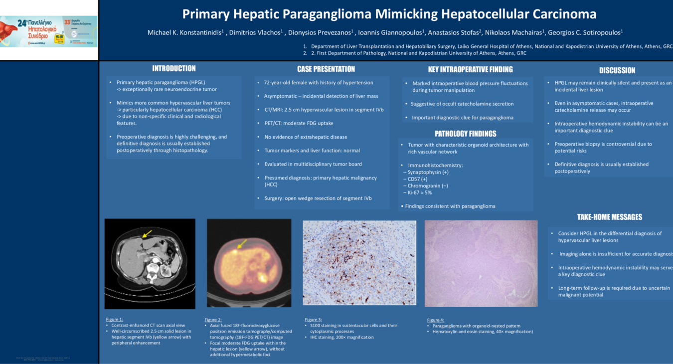 Primary Hepatic Paraganglioma Mimicking Hepatocellular Carcinoma
