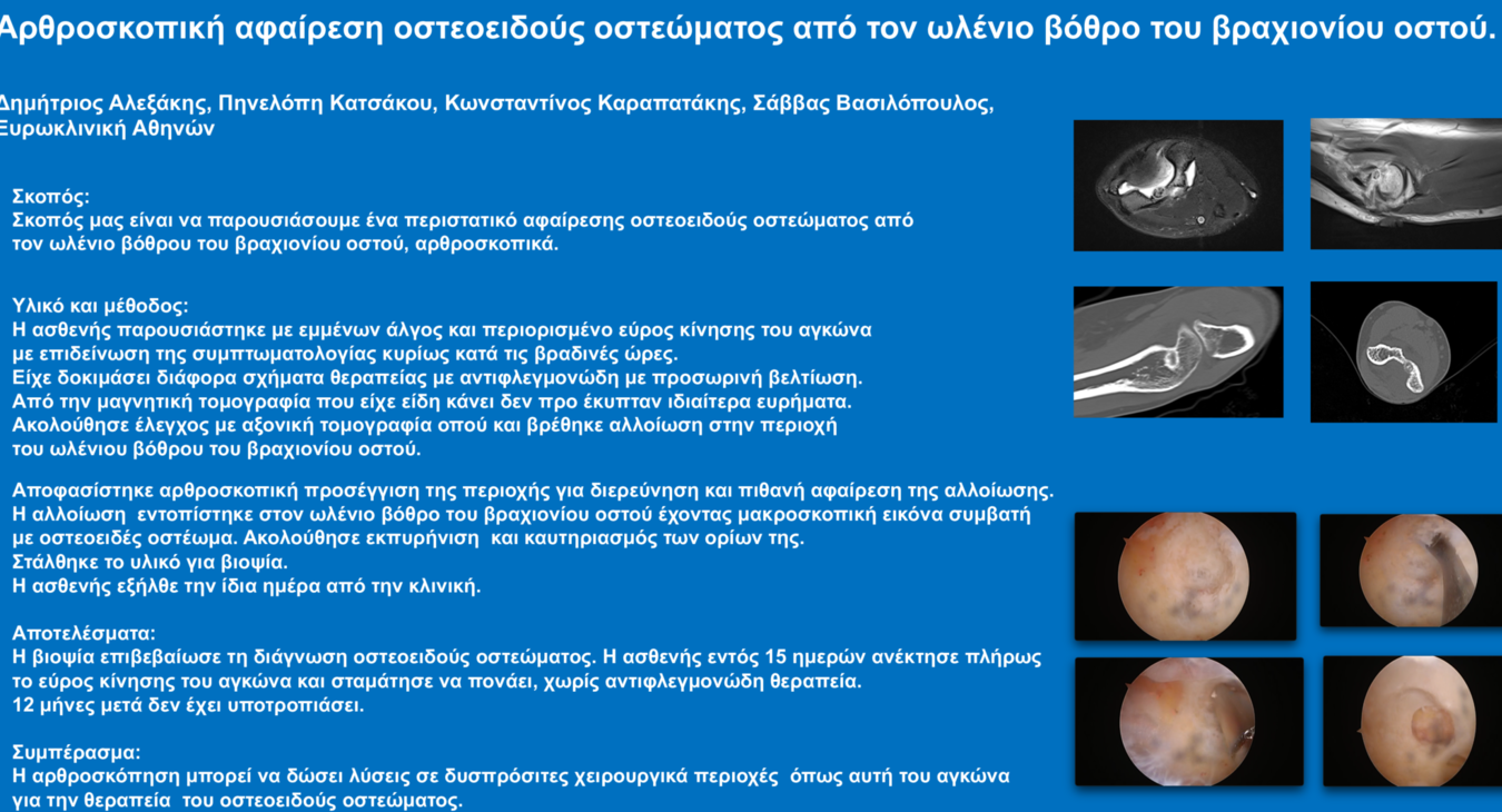 Αρθροσκοπική αφαίρεση οστεοειδούς οστεώματος από τον ωλένιο βόθρο του βραχιονίου οστού