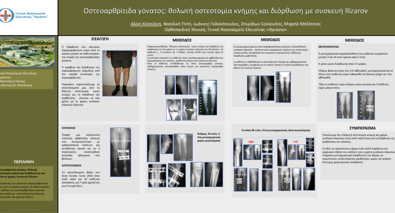Οστεοαρθρίτιδα γόνατος: θολωτή οστεοτομία κνήμης και διόρθωση με συσκευή Ilizarov