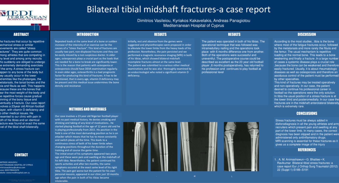 bilateral tibial midshaft stress fractures-a case report