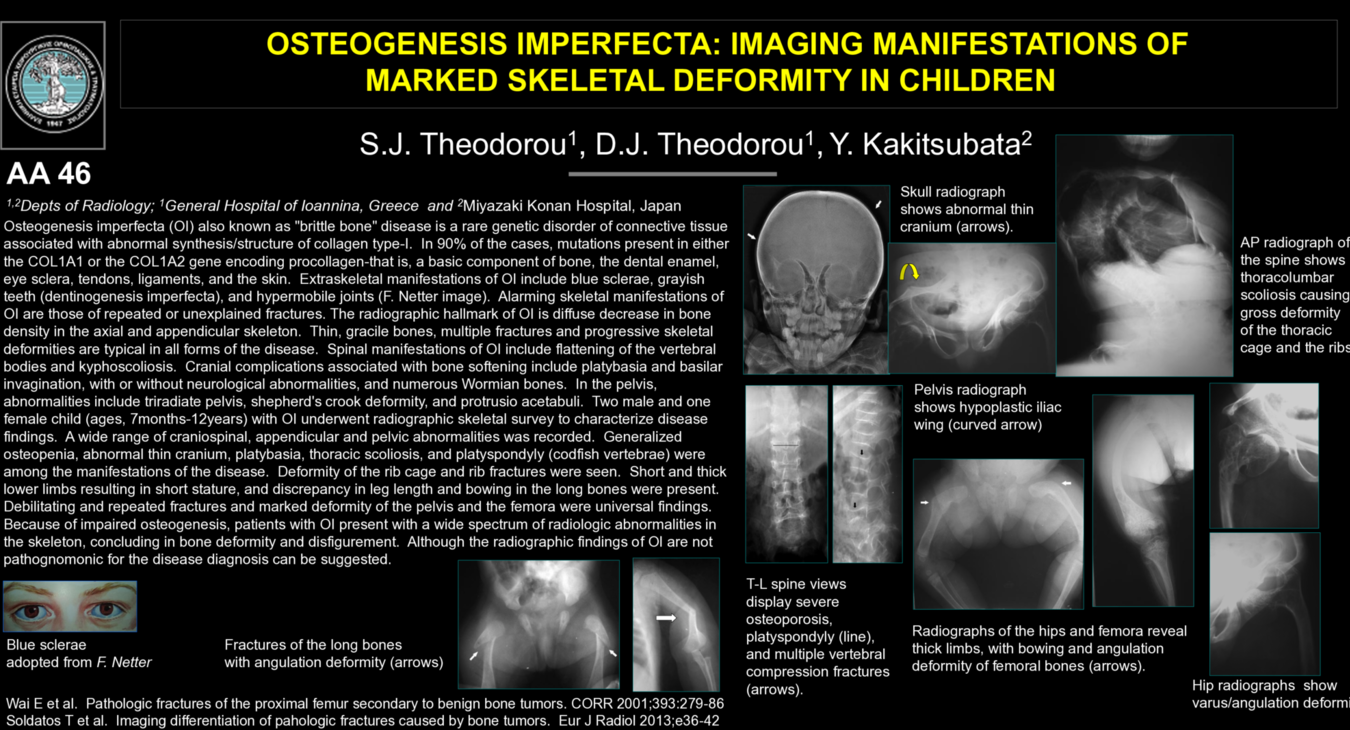 S. THEODOROU, Osteogenesis Imperfecta