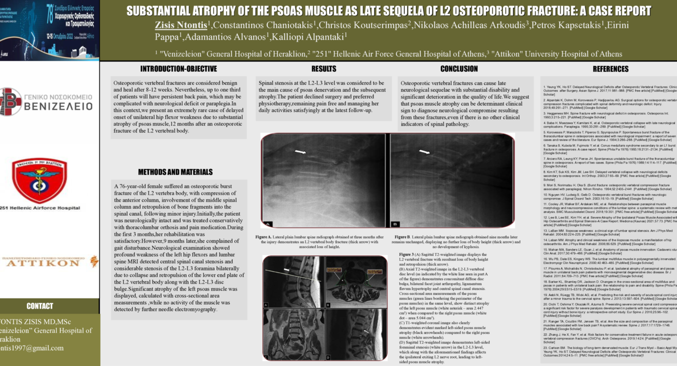 SUBSTANTIAL ATROPHY OF THE PSOAS MUSCLE AS LATE SEQUELA OF L2 OSTEOPOROTIC FRACTURE: A CASE REPORT