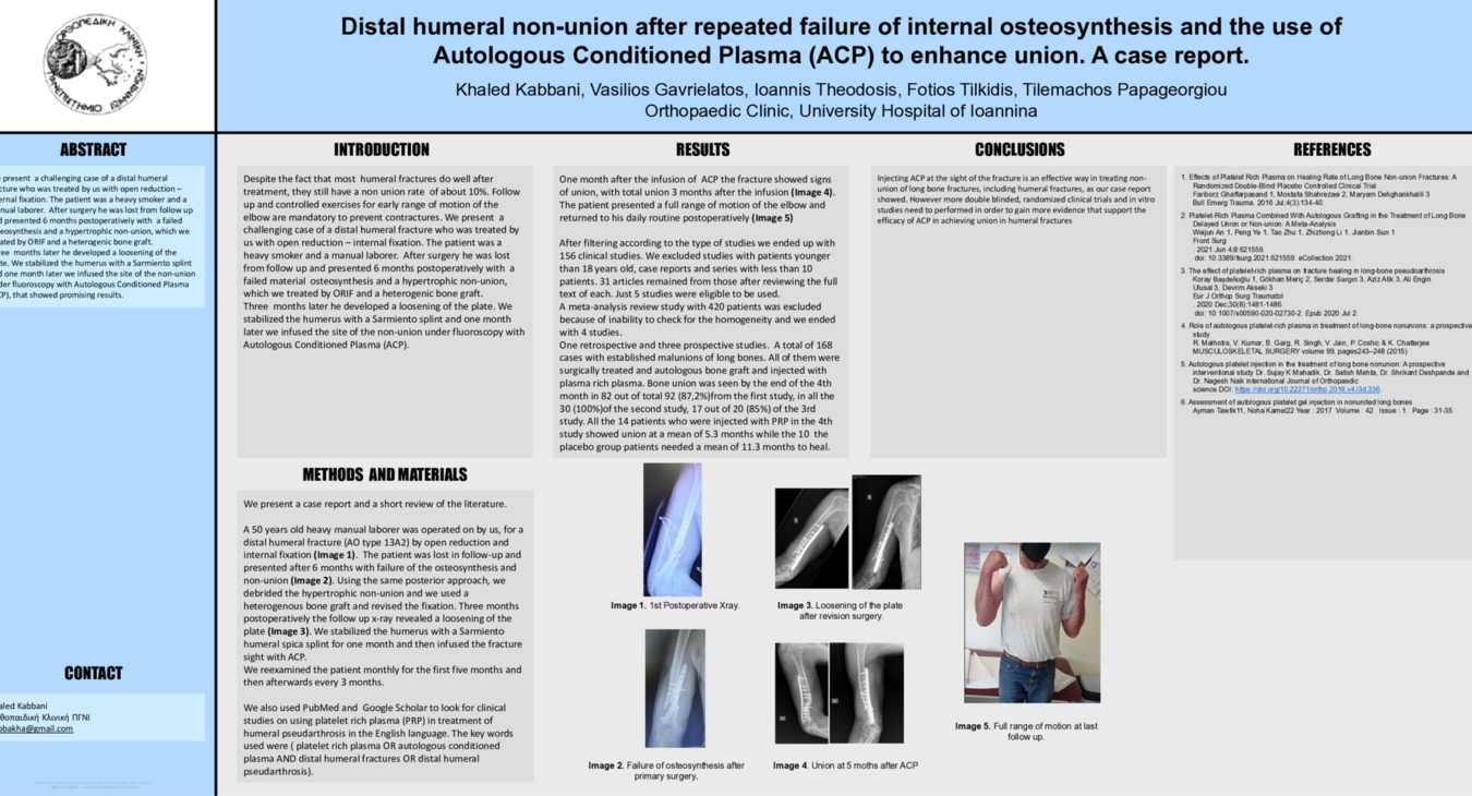 DISTAL HUMERAL PSEUDARTHROSIS ΑFTER REPEATED FAILURE OF INTERNAL OSTEOSYNTHESIS AND THE USE OF PLASMA-RICH PLATELETS: CASE REPOR