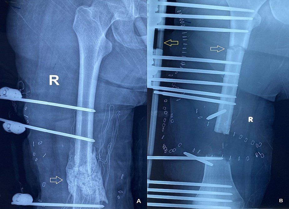 1. A. Sequential debridements resulted in a bone defect that was initially filled with polymethylmethacrylate (PMMA) cement (white arrow). B. The cement was later removed and a segmental bone transport was initiated to fill the bone defect and to correct the leg length discrepancy. The distraction site is seen proximally (white arrow) and the unilateral external fixator to the left (yellow arrow).