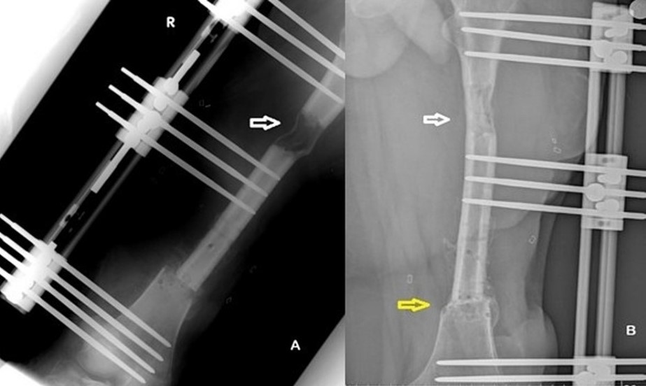 2. A. End of bone transport at three months post-operatively. New bone formation is obvious at the distraction site (white arrow).    B. Consolidation at the distraction site (white arrow) and callus formation at the docking site (yellow arrow) eight months postoperatively.