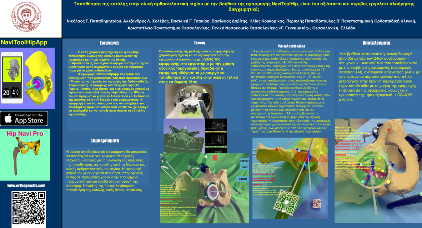 Navigation, augmented, Robotic, reality, total, hip, replacement, arthroplasty, THA, THR,, orientation, femur, Leg, length, offs