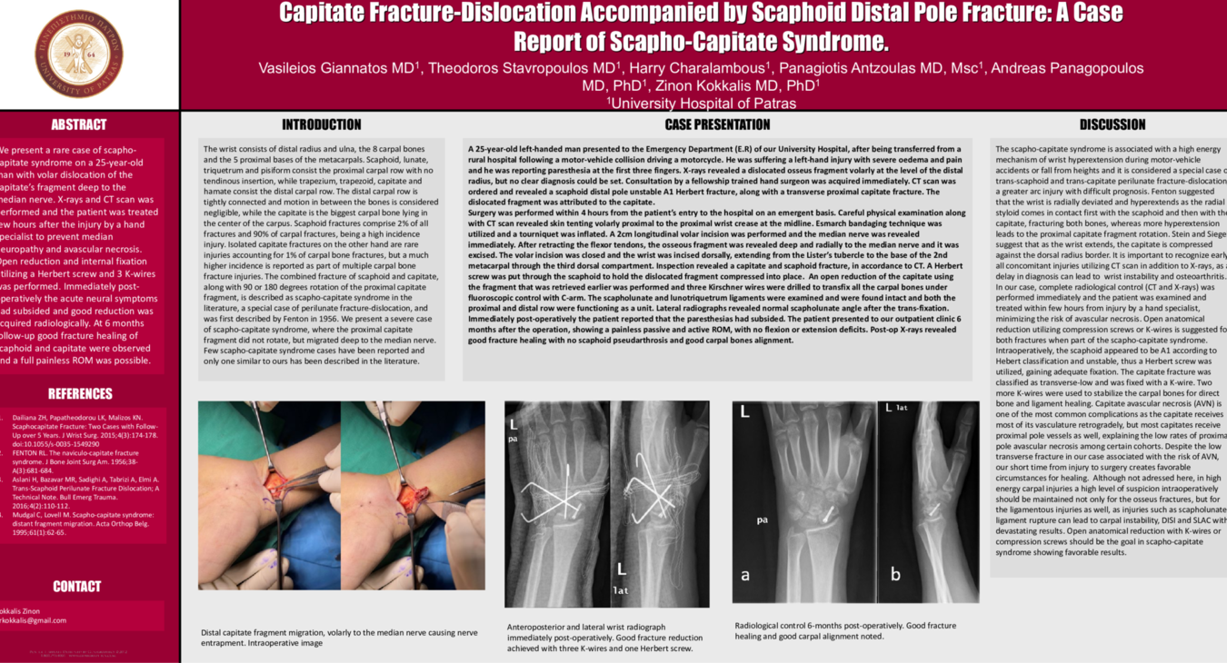 Scaphocapitate Syndrome Poster