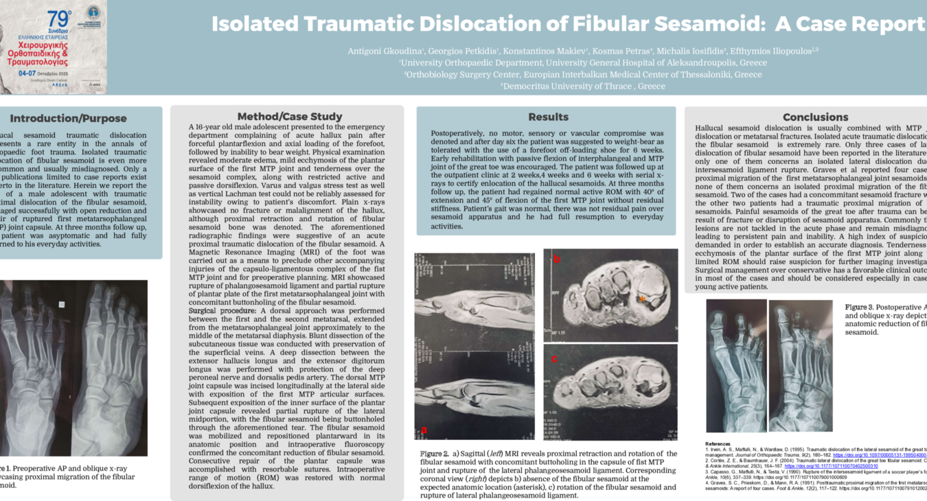 Isolated traumatic dislocation of fibular sesamoid