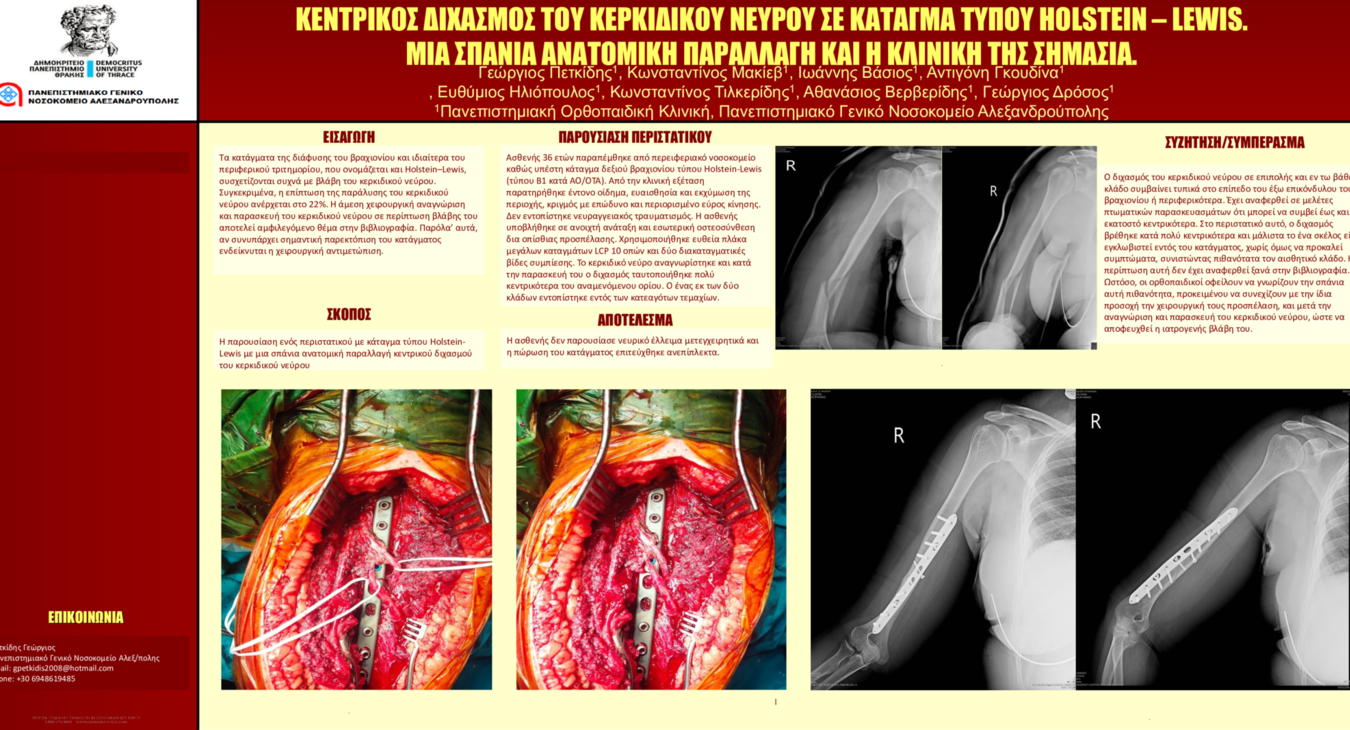 ΚΕΝΤΡΙΚΟΣ ΔΙΧΑΣΜΟΣ ΤΟΥ ΚΕΡΚΙΔΙΚΟΥ ΝΕΥΡΟΥ ΣΕ ΚΑΤΑΓΜΑ ΤΥΠΟΥ HOLSTEIN- LEWIS. ΜΙΑ ΣΠΑΝΙΑ ΑΝΑΤΟΜΙΚΗ ΠΑΡΑΛΛΑΓΗ ΚΑΙ Η ΚΛΙΝΙΚΗ ΤΗΣ ΣΗΜΑ