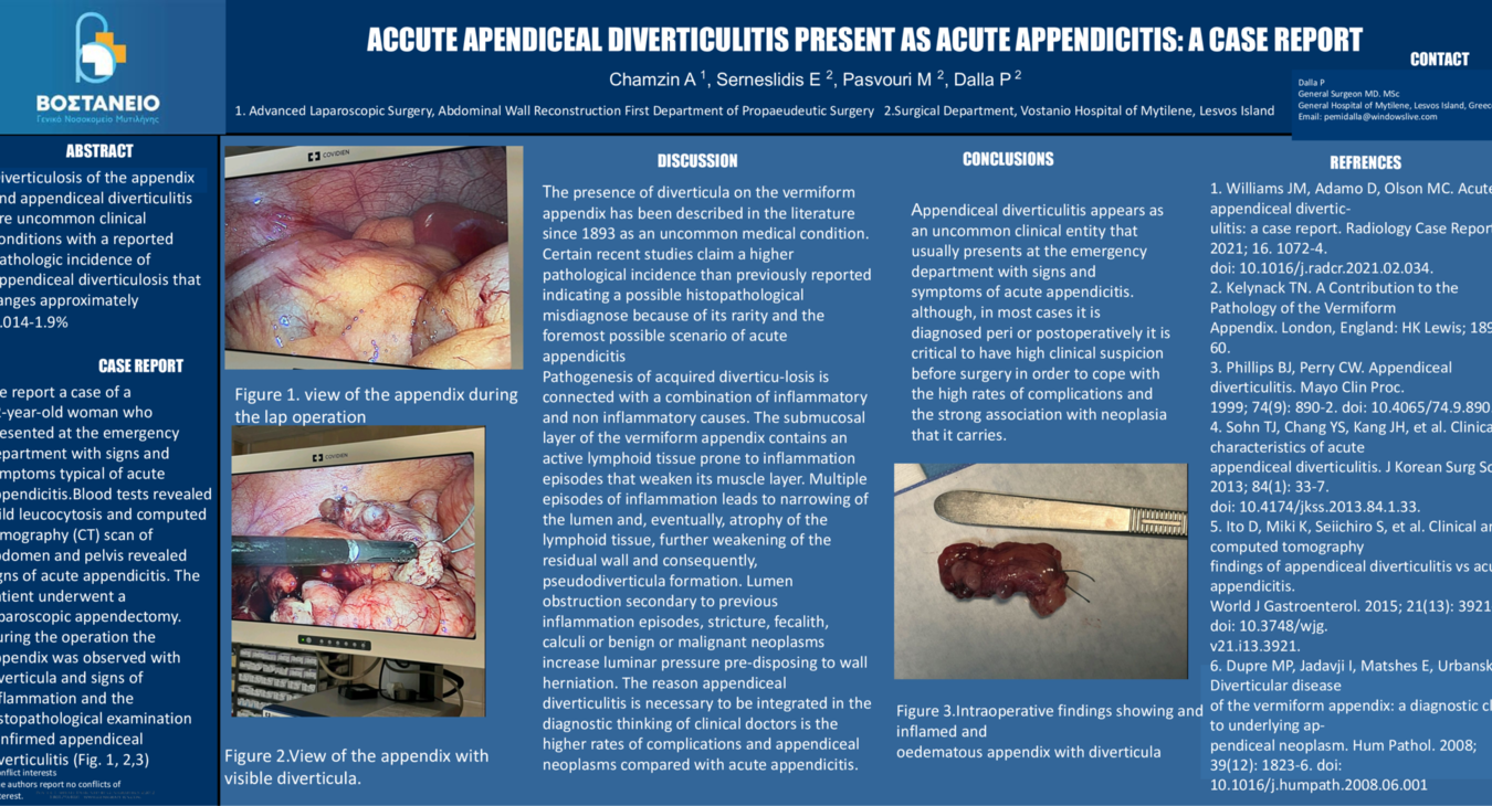 ACUTE APPENDICEAL DIVERTICULITIS PRESENT AS ACUTE APPENDICITIS: A CASE REPORT