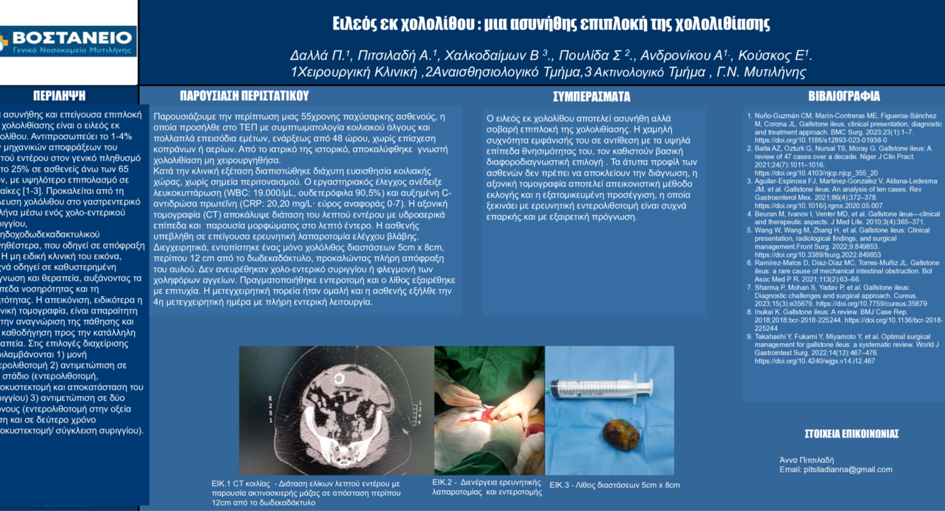 GALLSTONE ILEUS IN A MIDDLE-AGED OBESE FEMALE: A CASE REPORT