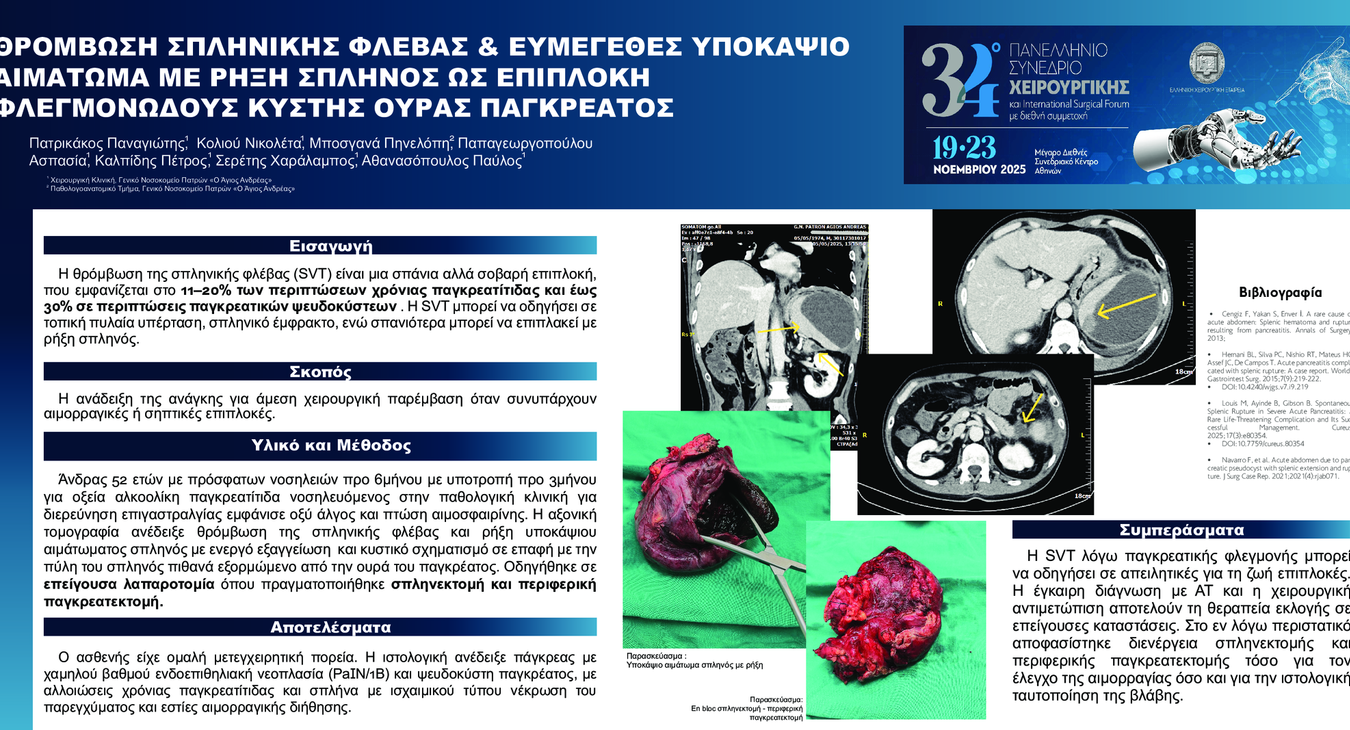 ΘΡΟΜΒΩΣΗ ΣΠΛΗΝΙΚΗΣ ΦΛΕΒΑΣ ΚΑΙ ΕΥΜΕΓΕΘΕΣ ΥΠΟΚΑΨΙΟ ΑΙΜΑΤΩΜΑ ΜΕ ΡΗΞΗ ΣΠΛΗΝΟΣ ΩΣ ΕΠΙΠΛΟΚΗ ΦΛΕΓΜΟΝΩΔΟΥΣ ΚΥΣΤΗΣ ΟΥΡΑΣ ΠΑΓΚΡΕΑΤΟΣ