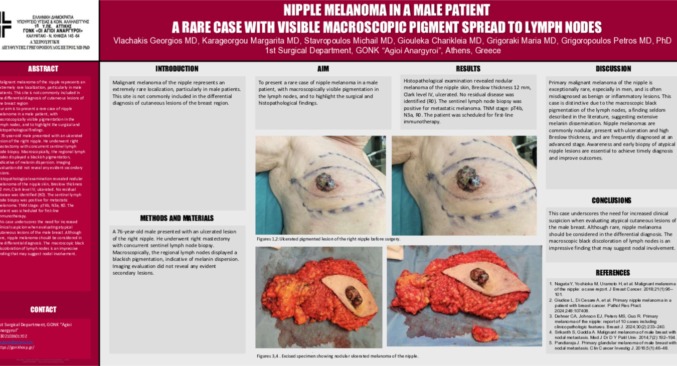 eposter ΜΕΛΑΝΩΜΑ ΘΗΛΗΣ