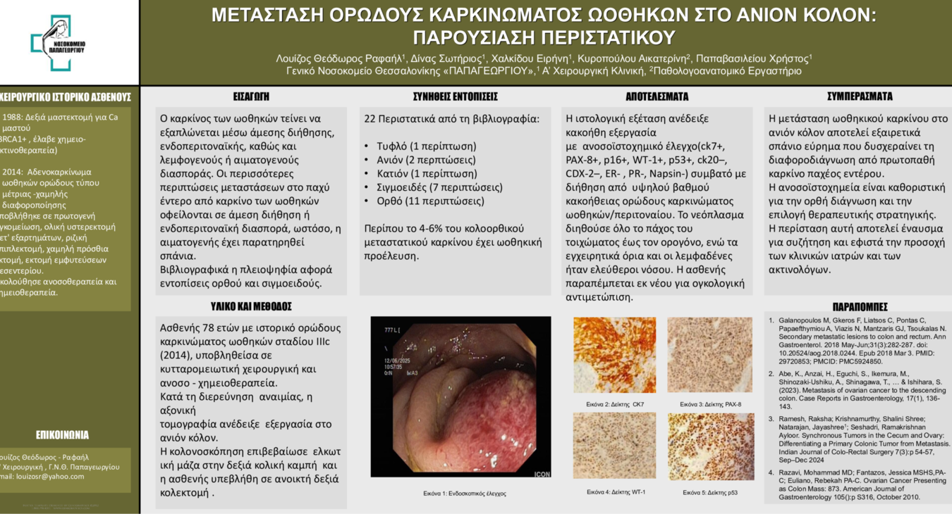 ΜΕΤΑΣΤΑΣΗ ΟΡΩΔΟΥΣ ΚΑΡΚΙΝΩΜΑΤΟΣ ΩΟΘΗΚΩΝ ΣΤΟ ΑΝΙΟΝ ΚΟΛΟΝ: ΠΑΡΟΥΣΙΑΣΗ ΠΕΡΙΣΤΑΤΙΚΟΥ