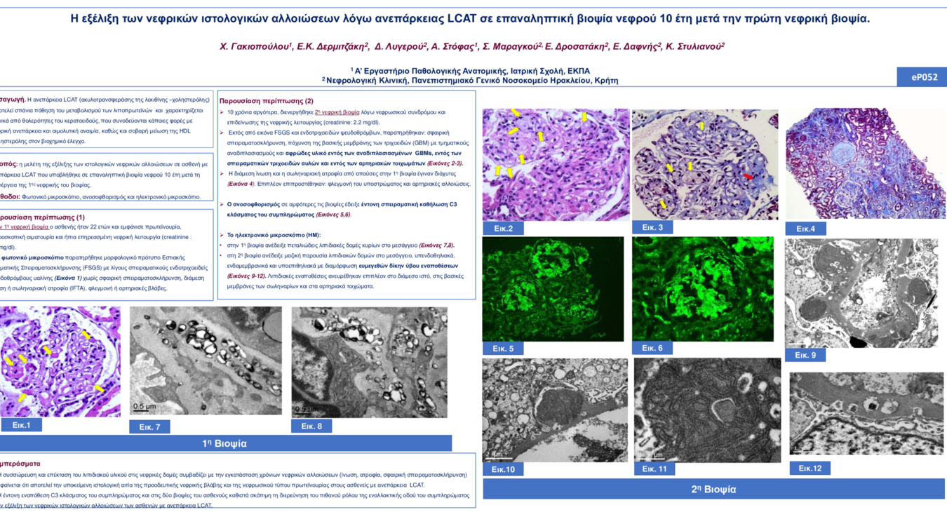 eP052 Η εξέλιξη των νεφρικών ιστολογικών αλλοιώσεων λόγω ανεπάρκειας LCAT σε επαναληπτική βιοψία νεφρού 10 έτη μετά