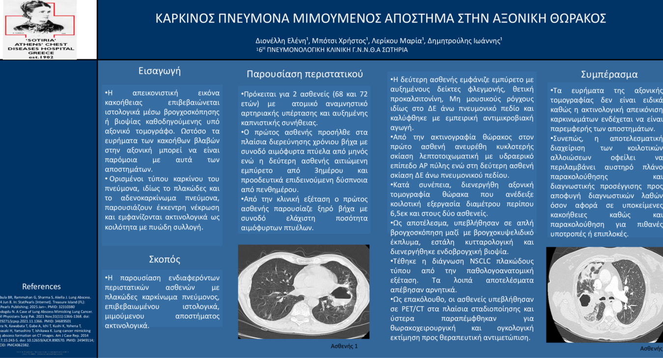 ΚΑΡΚΙΝΟΣ ΠΝΕΥΜΟΝΑ ΜΙΜΟΥΜΕΝΟΣ ΑΠΟΣΤΗΜΑ ΣΤΗΝ ΑΞΟΝΙΚΗ ΘΩΡΑΚΟΣ